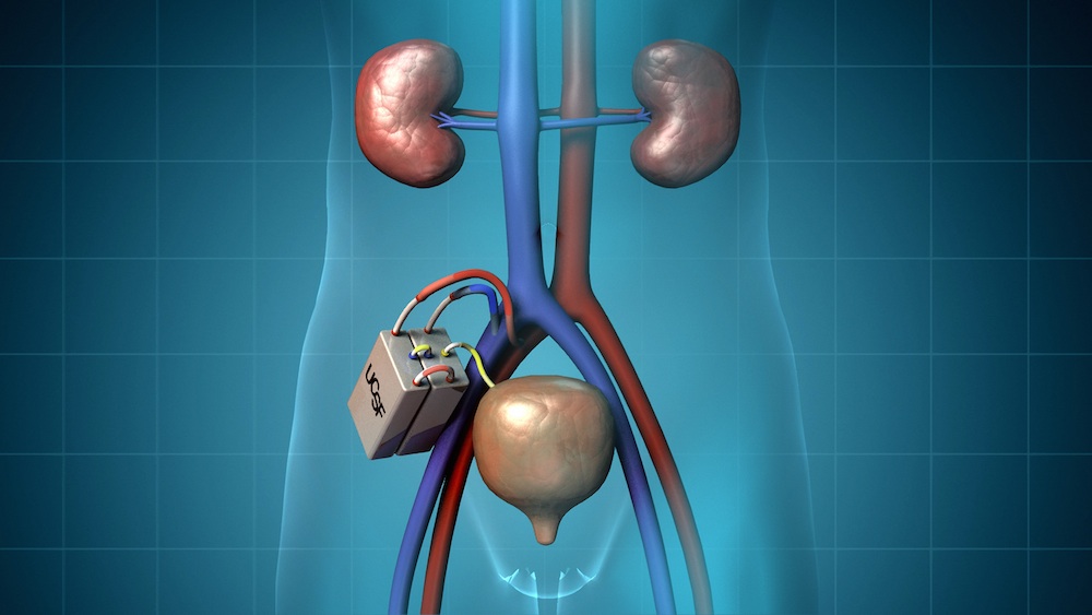 Bioartificial kidney comes a step closer
