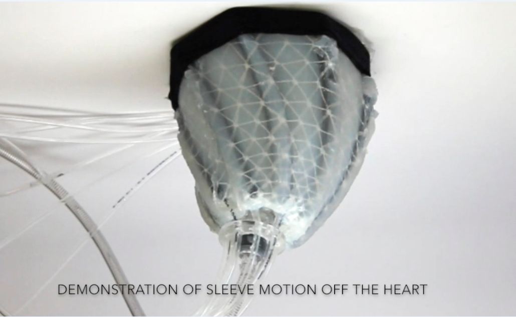 Flabby heart keeps pumping with squeeze from robotic sleeve