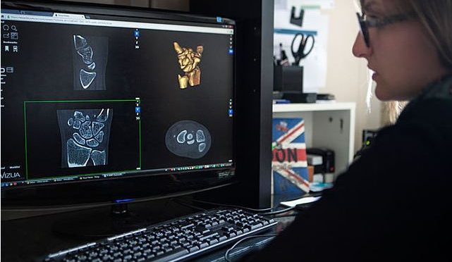 3D-printed vertebrae helps Indian woman walk again